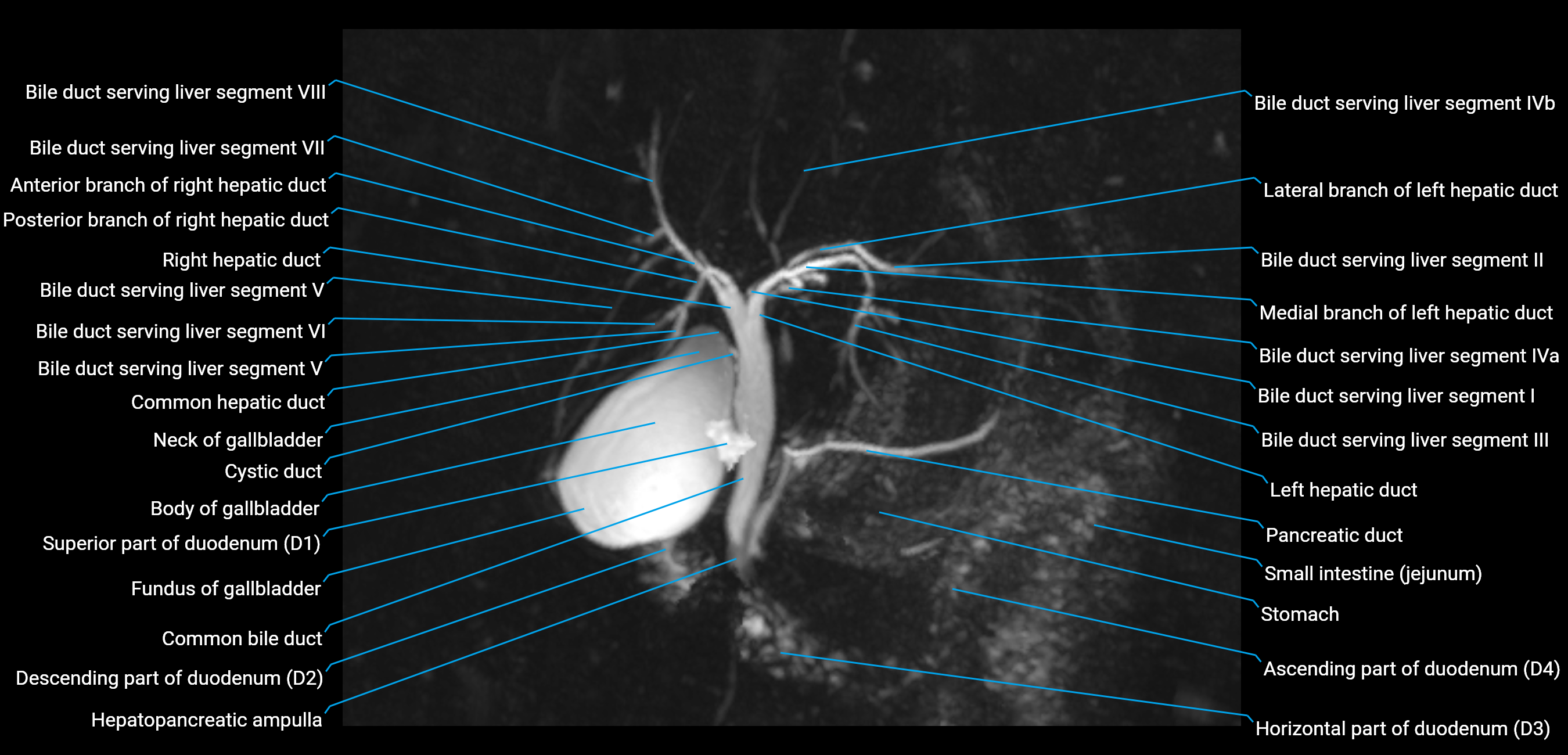 MRCP MIP MRI  anatomy labelled image-img-01003-00014.png